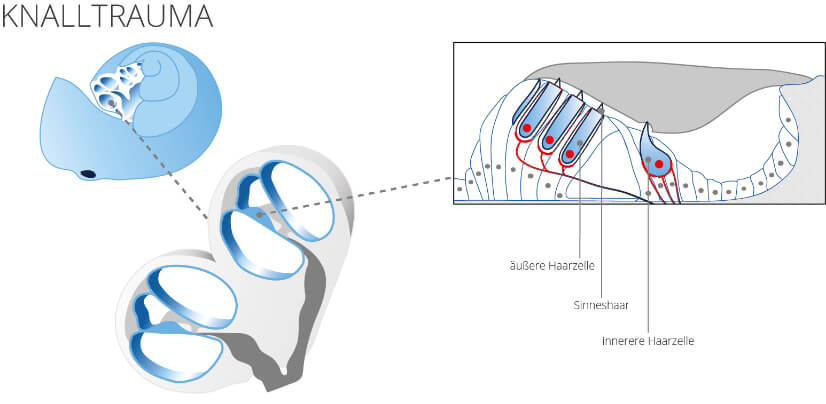 Knalltrauma Infografik
