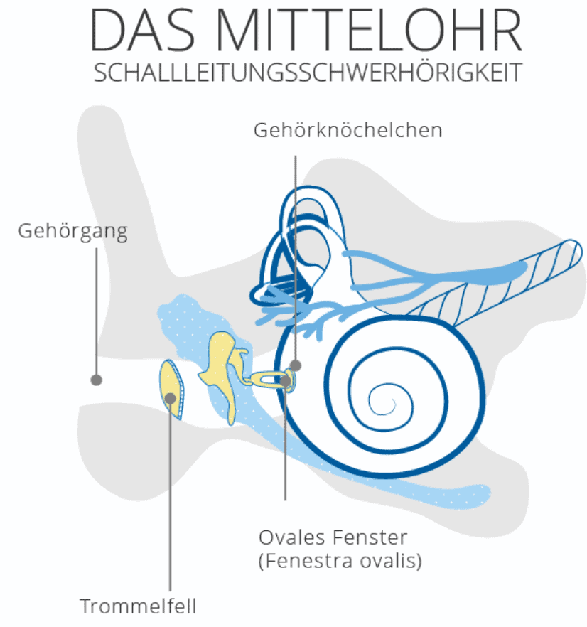 Mittelohr Schallleitungsschwerhörigkeit