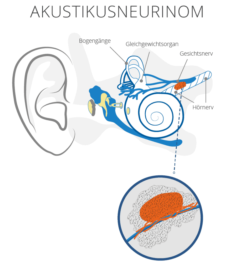 akustikusneurinom