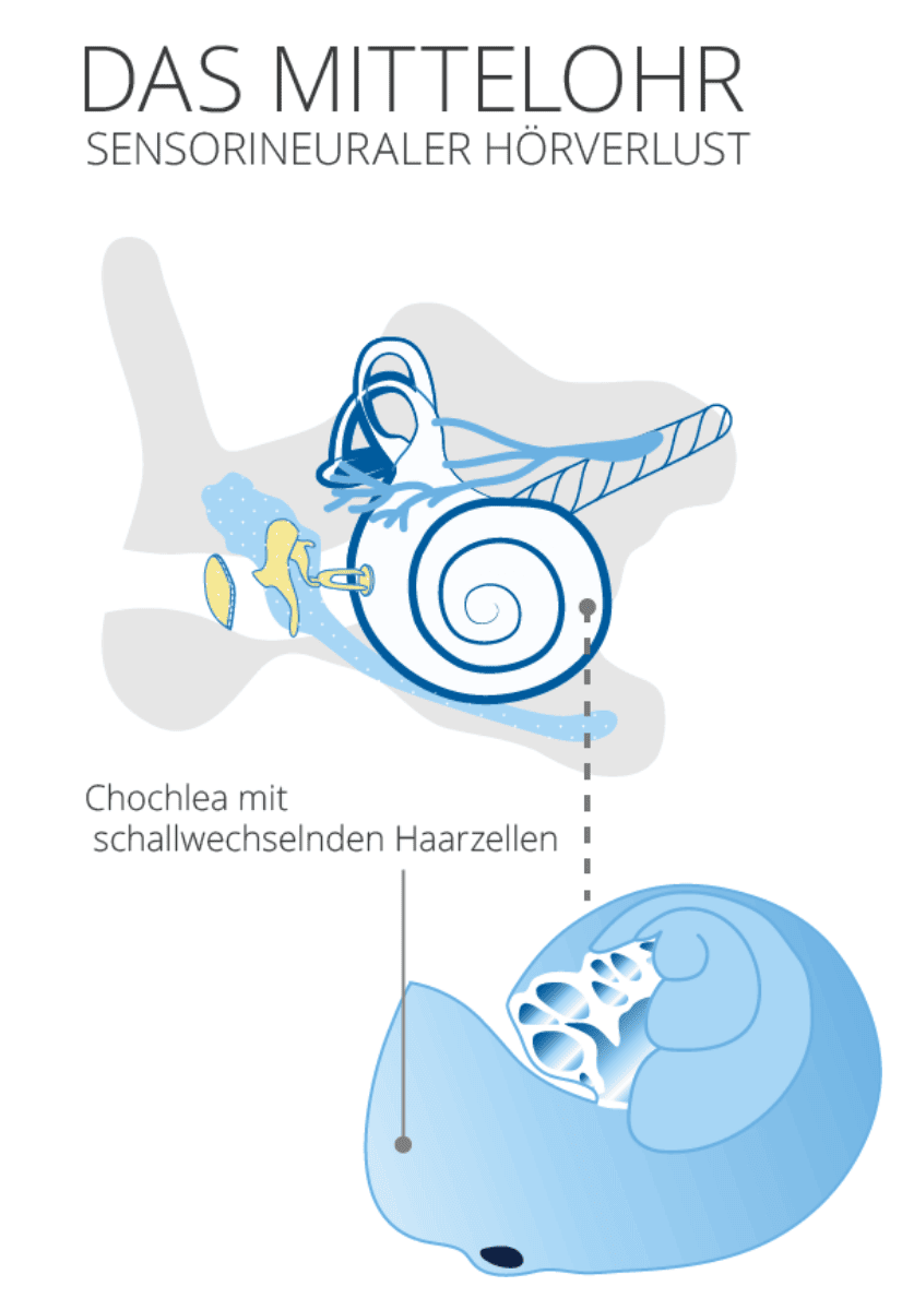 Mittelohr Sensorineuraler Hörverlust