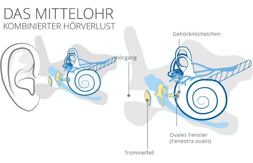 Mittelohr Kombinierter Hörverlust