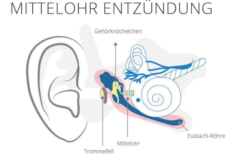 Mittelohr entzündung