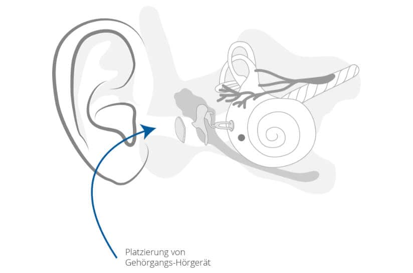 Gehörgangs-Hörgeräte