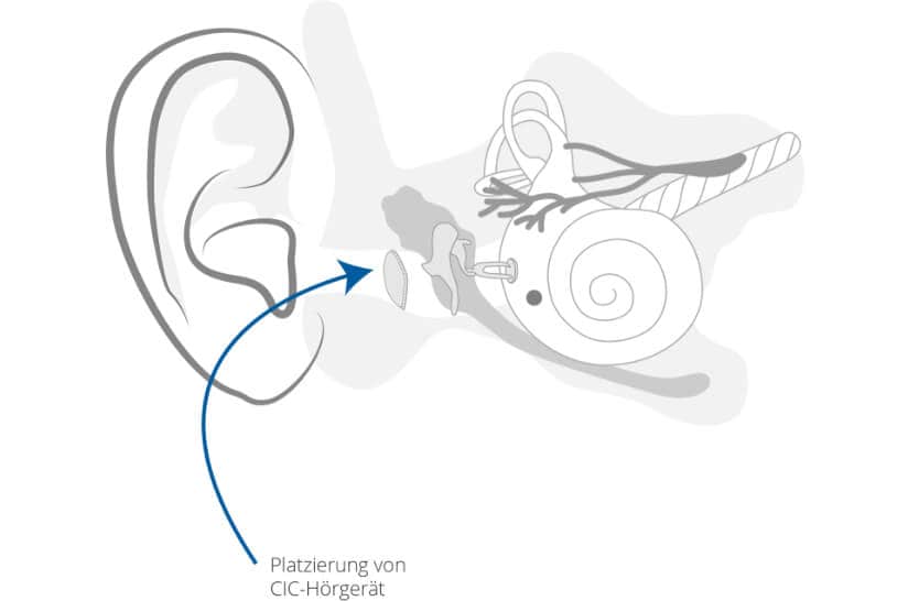 CIC-Hörgeräte