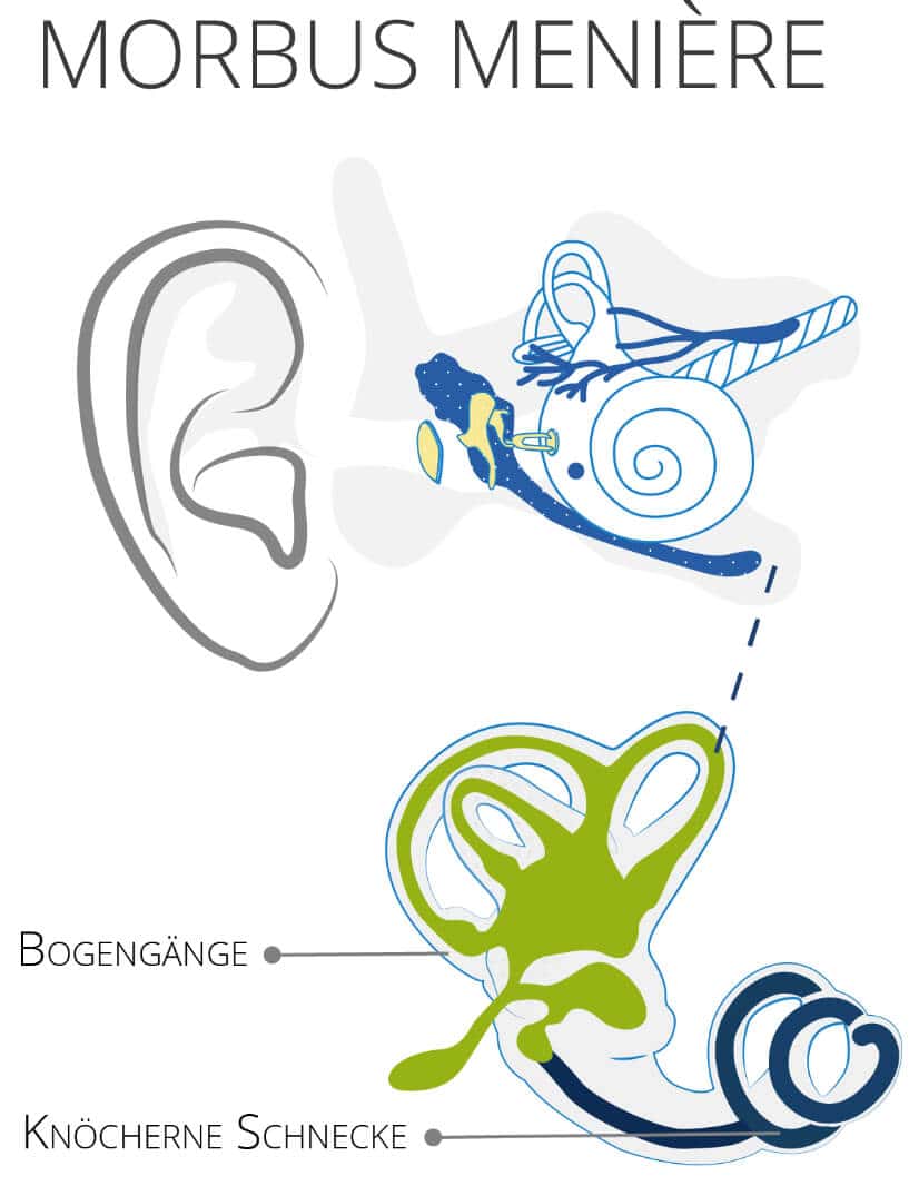 Morbus Meniére Infografik