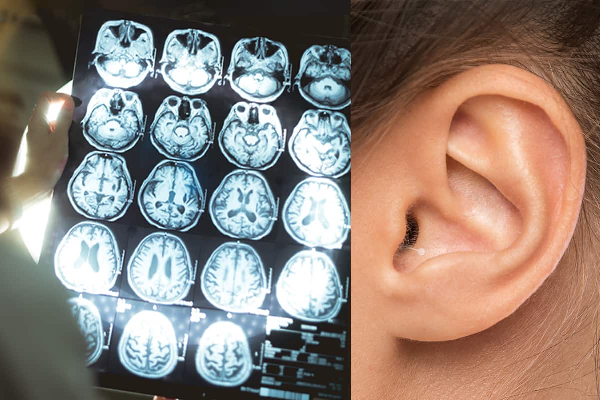 Gehirnscan: Hörverlust kann zu Demenz führen