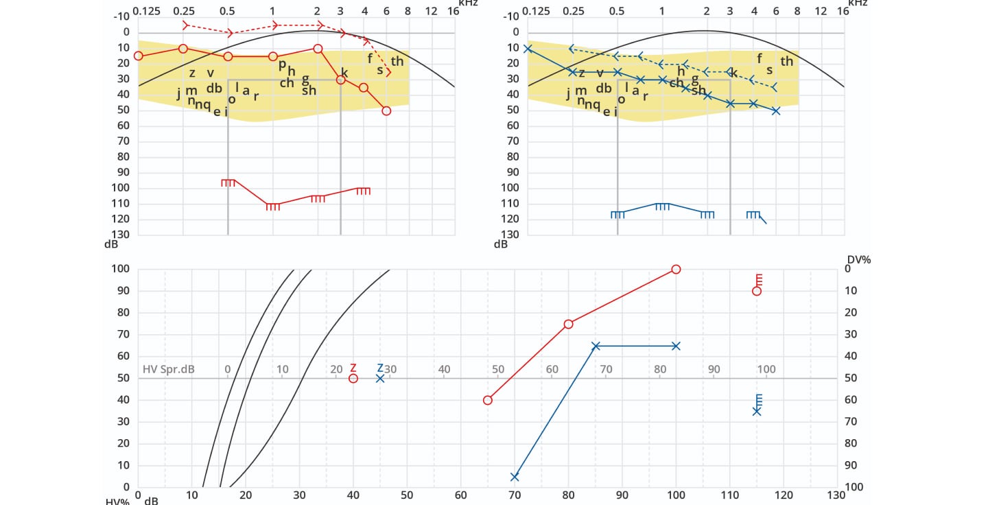 beispiel eines audiogramms